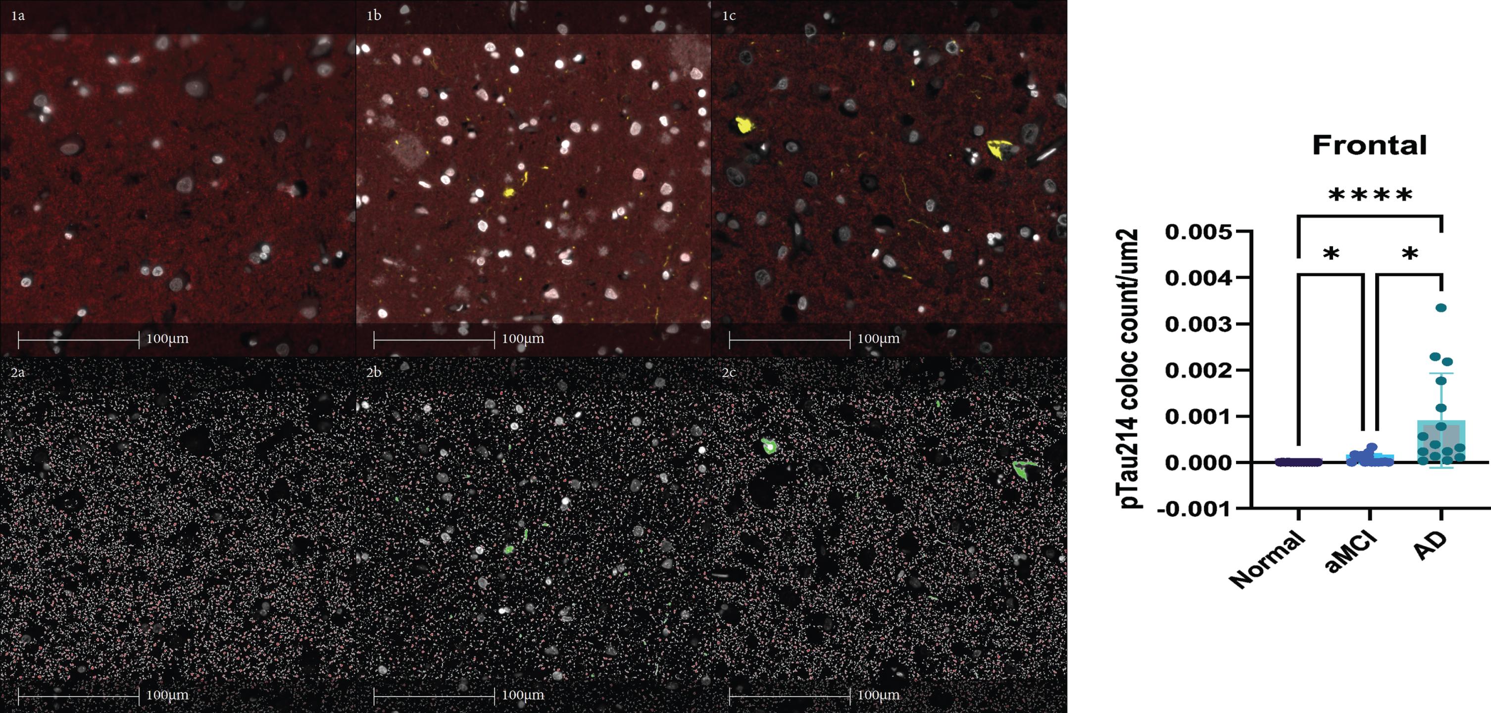 Accumulation of pTau231 at the Postsynaptic Density in Early ...